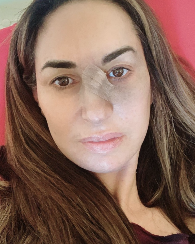 Basal Cell Carcinoma and My Mohs Surgery Experience - Natalie Jill Fitness